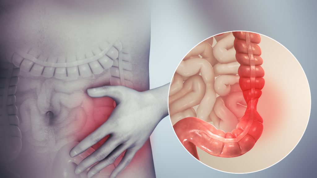 SYMPTOMS OF IRRITABLE BOWEL SYNDROME